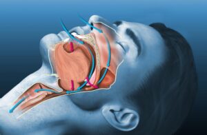 An anatomical illustration of a human head in profile view, with the internal structure of the mouth and throat visible, depicting the airway during sleep. The image highlights the soft palate, uvula, tongue, and throat muscles in shades of pink and red, against a contrasting blue background representing the skin. The illustration is designed to educate on the mechanics of breathing or issues such as sleep apnea.